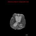 Atypical teratoid rhabdoid tumor (Radiopaedia 10712-11183 Axial DWI 7).jpg
