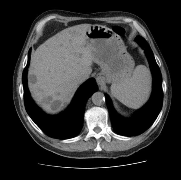 File:Autosomal dominant polycystic kidney disease (Radiopaedia 27851-28094 Axial non-contrast 49).jpg