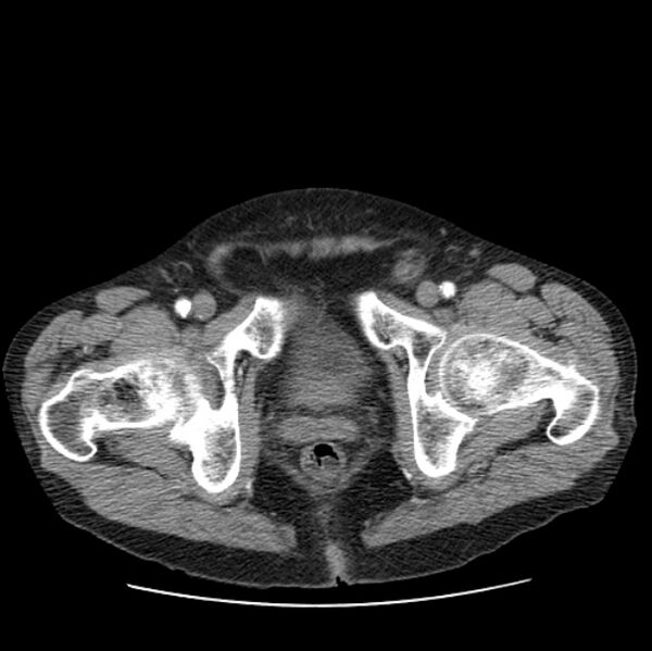 File:Autosomal dominant polycystic kidney disease (Radiopaedia 27851-28094 B 119).jpg
