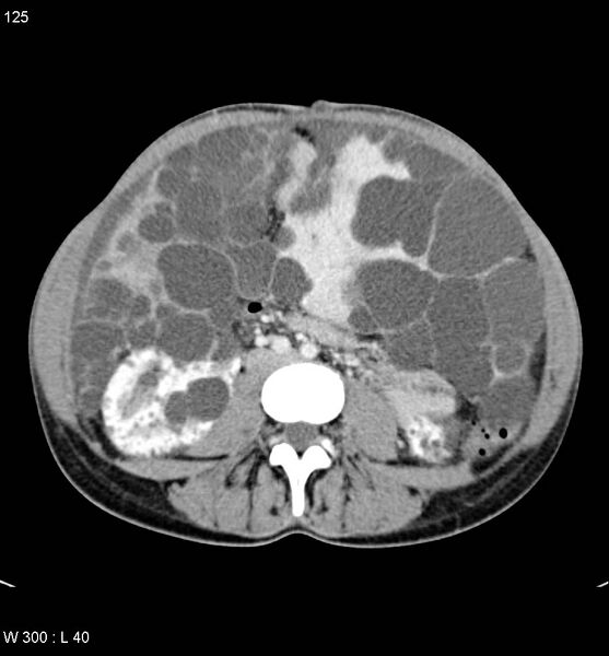 File:Autosomal dominant polycystic kidney disease with extensive hepatic involvement (Radiopaedia 5204-6971 B 17).jpg