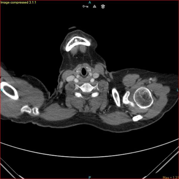 File:Azygos vein aneurysm (Radiopaedia 77824-90130 B 1).jpg