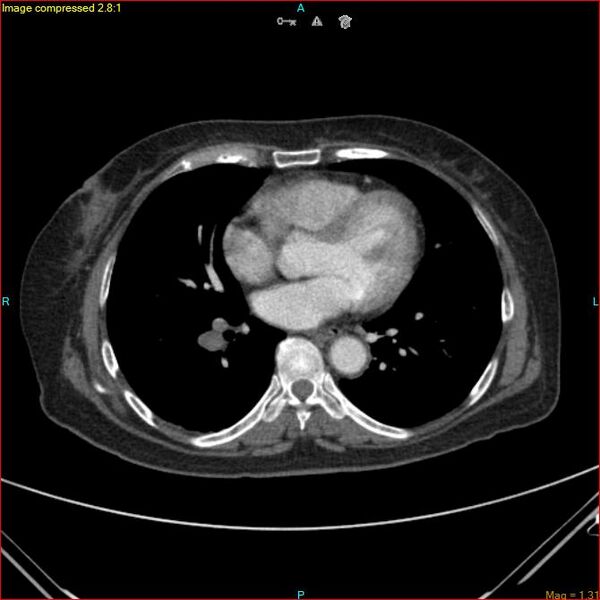 File:Azygos vein aneurysm (Radiopaedia 77824-90130 B 35).jpg