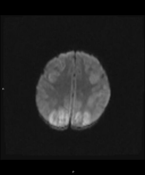 File:Basal ganglia and parenchymal ischemia (Radiopaedia 45818-50084 Axial DWI 17).jpg