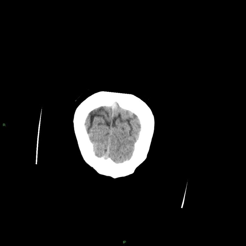 Basal ganglia hemorrhage (Radiopaedia 58349-65472 Coronal non-contrast 7).jpg