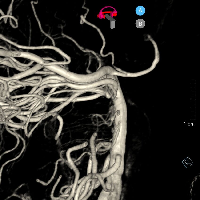 Basilar artery perforator aneurysm (Radiopaedia 82455-97734 3D view left VA 137).jpg