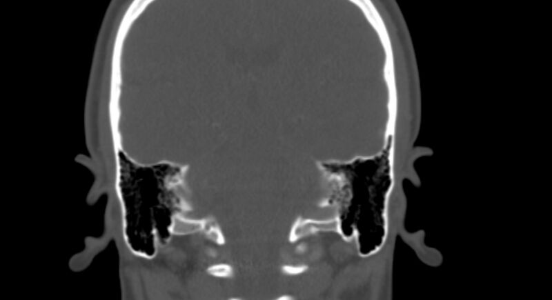 File:Benign mixed salivary tumor of the parotid gland (Radiopaedia 35261-36792 Coronal bone window 24).jpg