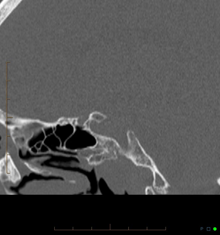 Benign notochordal cell tumor (probable) (Radiopaedia 65475-74546 Sagittal bone window 9).jpg