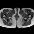 Bicornuate uterus (Radiopaedia 61974-70046 Axial T1 45).jpg