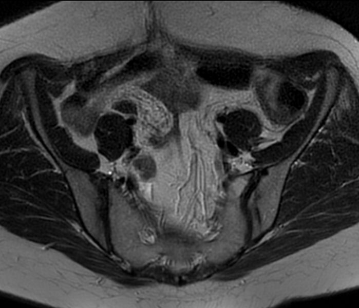 File:Bicornuate uterus (Radiopaedia 76407-88114 Axial T2 4).jpg