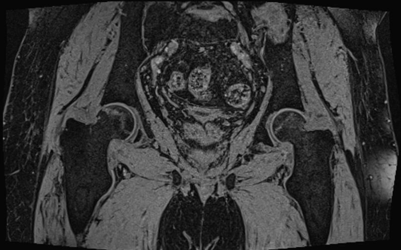 File:Bilateral avascular necrosis of femoral head (Radiopaedia 77116-89078 Coronal T2 we 24).jpg