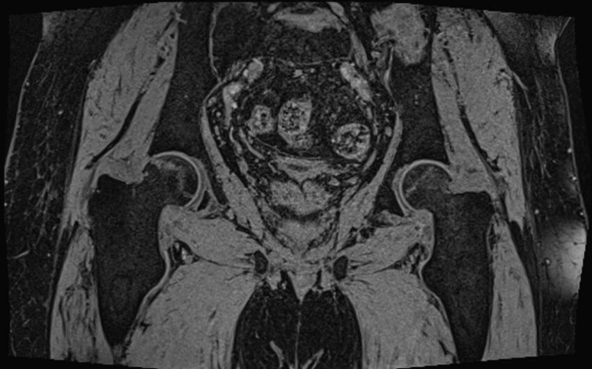 Bilateral avascular necrosis of femoral head (Radiopaedia 77116-89078 Coronal T2 we 24).jpg