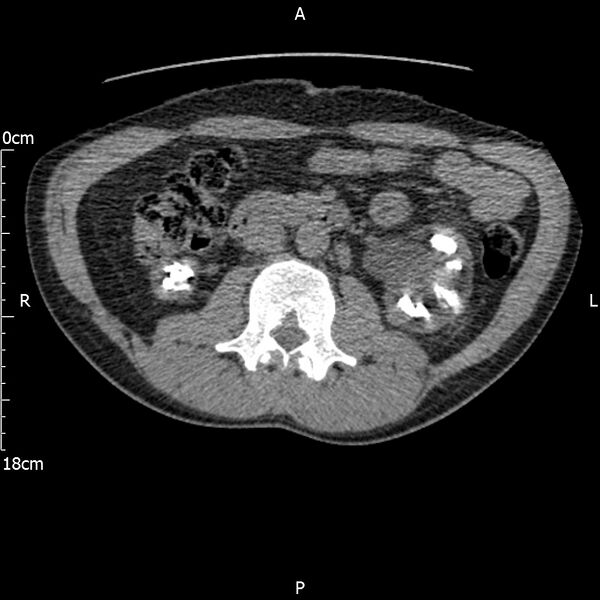 File:Bilateral medullary nephrocalcinosis with ureteric calculi (Radiopaedia 71269-81569 Axial non-contrast 52).jpg