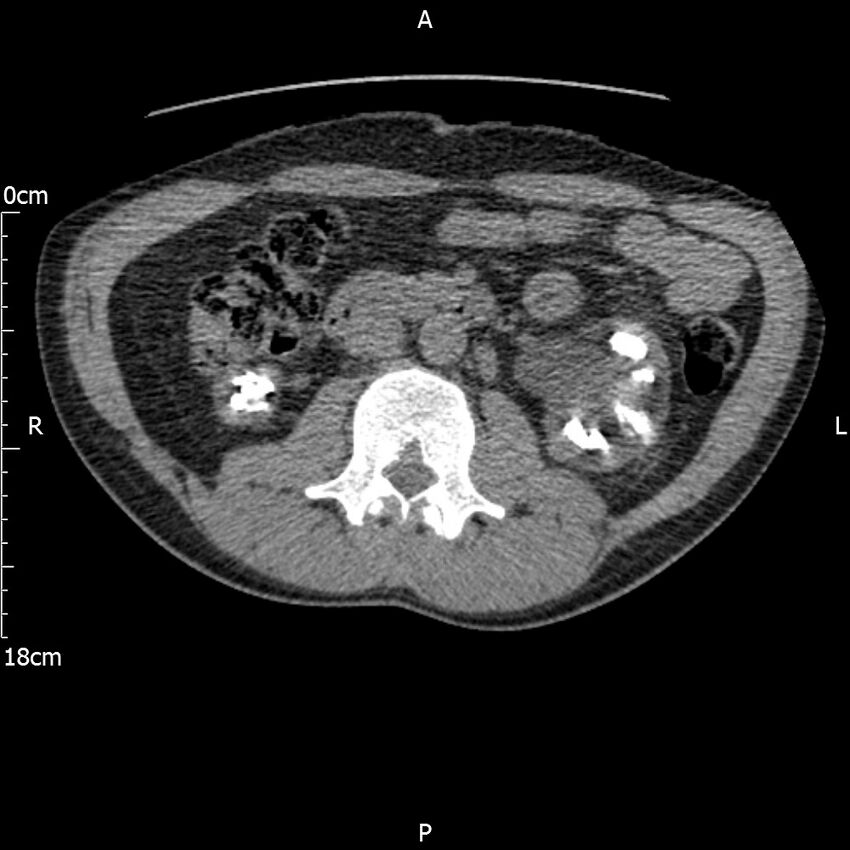 Bilateral medullary nephrocalcinosis with ureteric calculi (Radiopaedia 71269-81569 Axial non-contrast 52).jpg