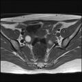 Bilateral ovarian endometriomas (Radiopaedia 87085-103347 Axial T1 8).jpg