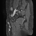 Bilateral ovarian endometriomas (Radiopaedia 87085-103347 F 21).jpg