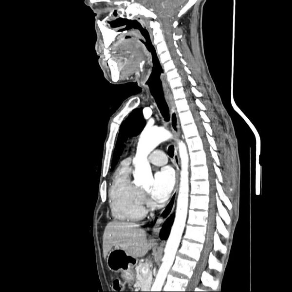 File:Bilateral parotid gland lymphoma (Radiopaedia 21038-20969 C 10).jpg