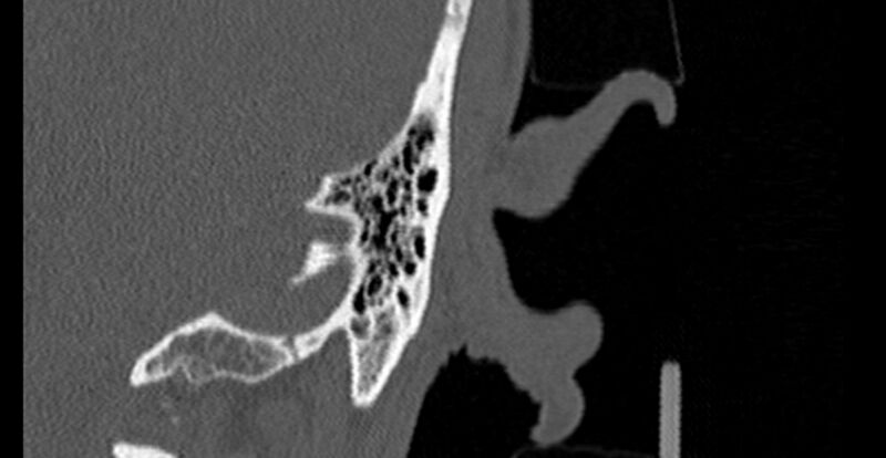 File:Bilateral temporal bone fractures (Radiopaedia 29482-29970 B 94).jpg