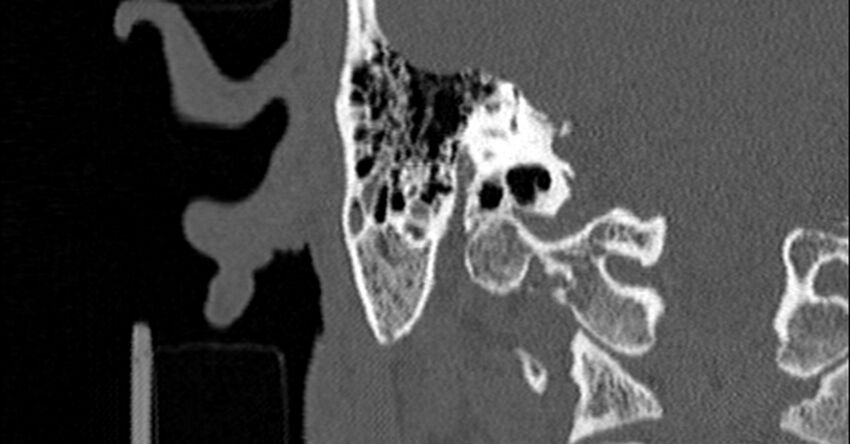 Bilateral temporal bone fractures (Radiopaedia 29482-29970 Coronal non-contrast 133).jpg
