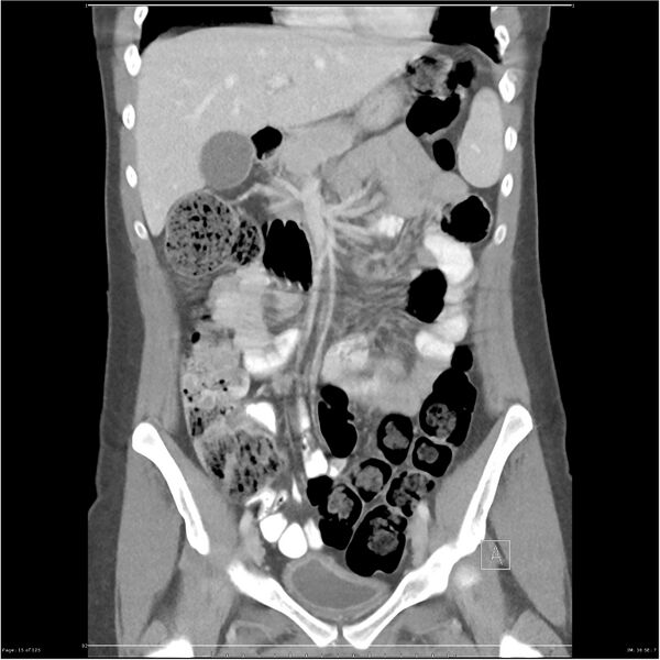 File:Bilateral ureteritis and cystitis (Radiopaedia 25340-25594 B 15).jpg