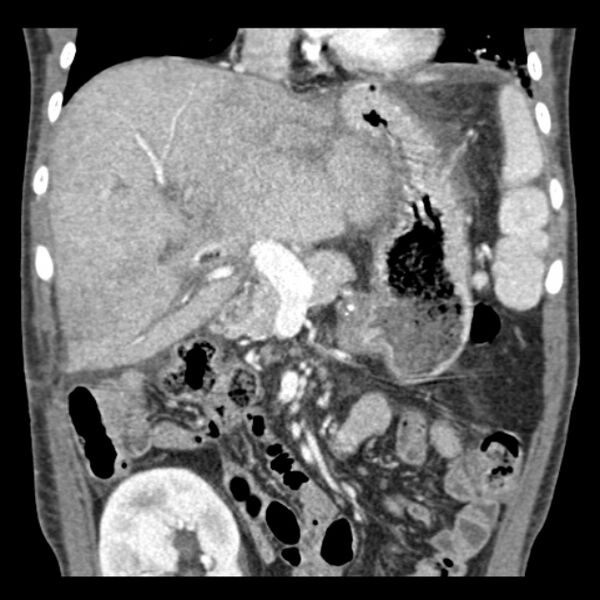 File:Biliary necrosis - liver transplant (Radiopaedia 21876-21846 C 20).jpg