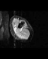 MRI mid-arm axial view