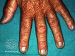 Blue nails due to minocycline (DermNet NZ hair-nails-sweat-blue-mino).jpg