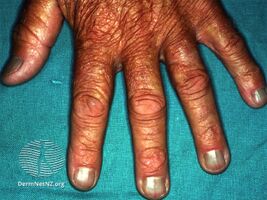 Blue nails due to minocycline