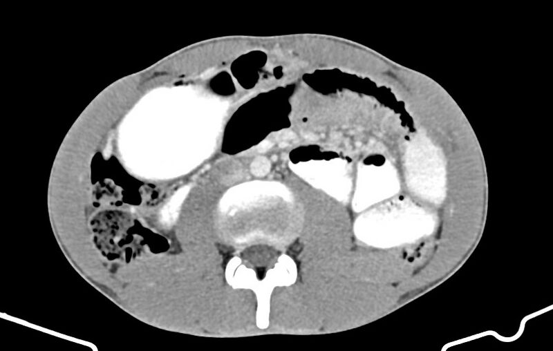 File:Blunt injury to the small bowel (Radiopaedia 74953-85987 A 91).jpg