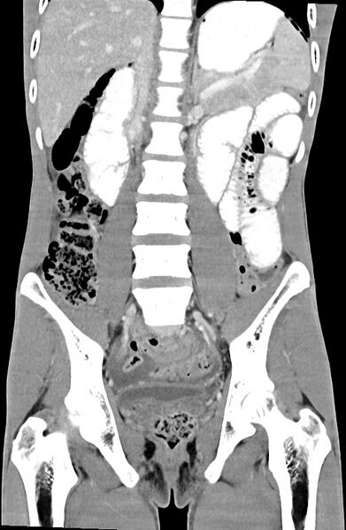 File:Blunt injury to the small bowel (Radiopaedia 74953-85987 B 57).jpg