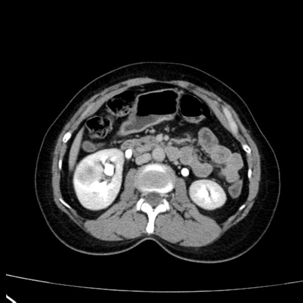 File:Bosniak renal cyst - type I (Radiopaedia 27479-27675 D 21).jpg