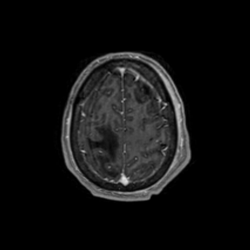 Brain abscess complicated by intraventricular rupture and ventriculitis (Radiopaedia 82434-96577 Axial T1 C+ 60).jpg