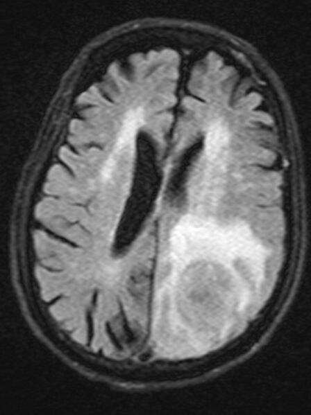 File:Brain abscess with dual rim sign (Radiopaedia 87566-103938 Axial FLAIR 15).jpg