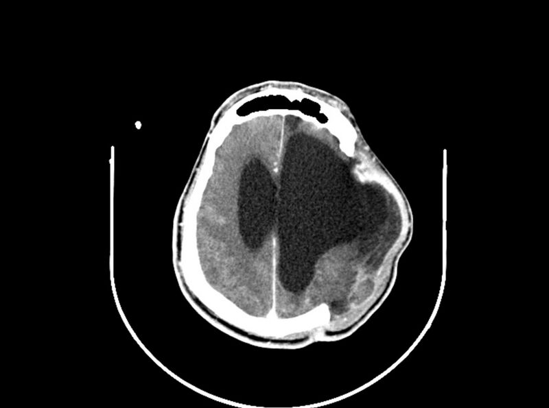 File:Brain injury by firearm projectile (Radiopaedia 82068-96088 B 157).jpg