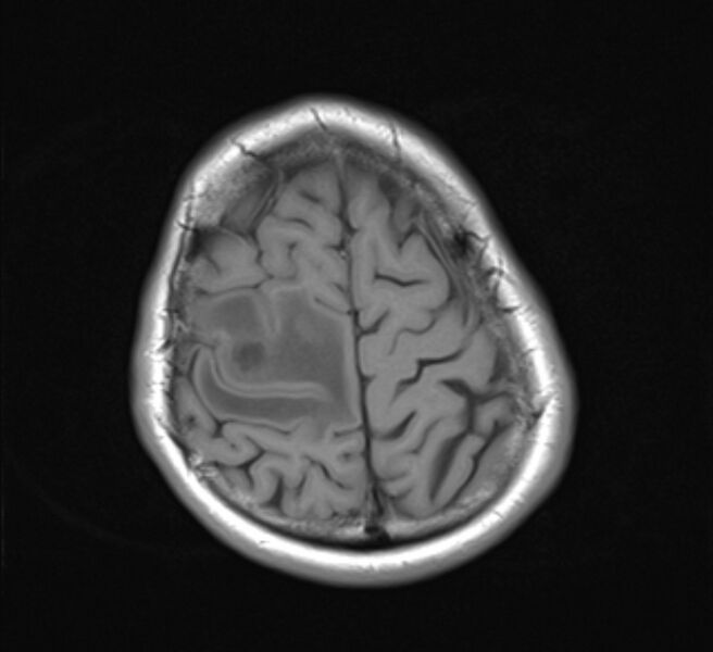 File:Brain metastases - lung cancer primary (Radiopaedia 75060-86115 Axial T1 21).jpg