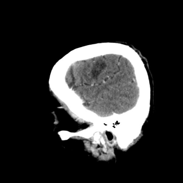 File:Brain metastases from lung cancer (Radiopaedia 24480-24781 C+ delayed 8).jpg