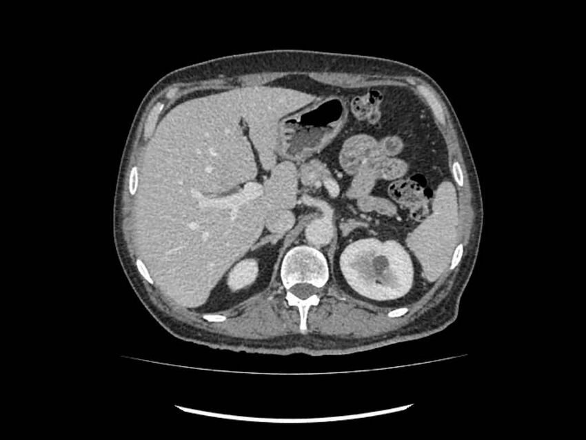 Brain metastases from renal cell carcinoma (Radiopaedia 42222-45328 B 32).jpg