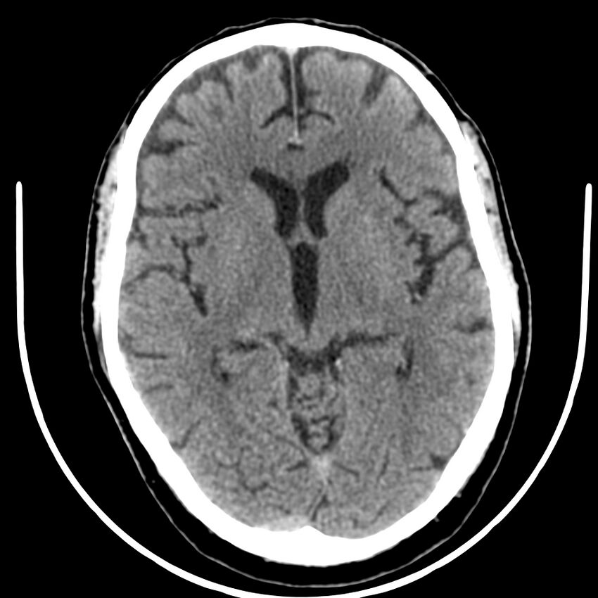 Brain metastasis (Radiopaedia 42617-45760 Axial non-contrast 21).jpg