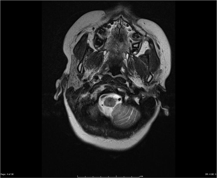 File:Brainstem glioma (Radiopaedia 21819-21775 Axial T2 4).jpg