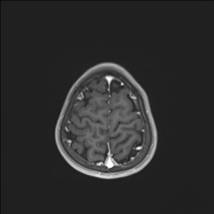 Brainstem glioma (Radiopaedia 70548-80674 Axial T1 C+ 136).jpg