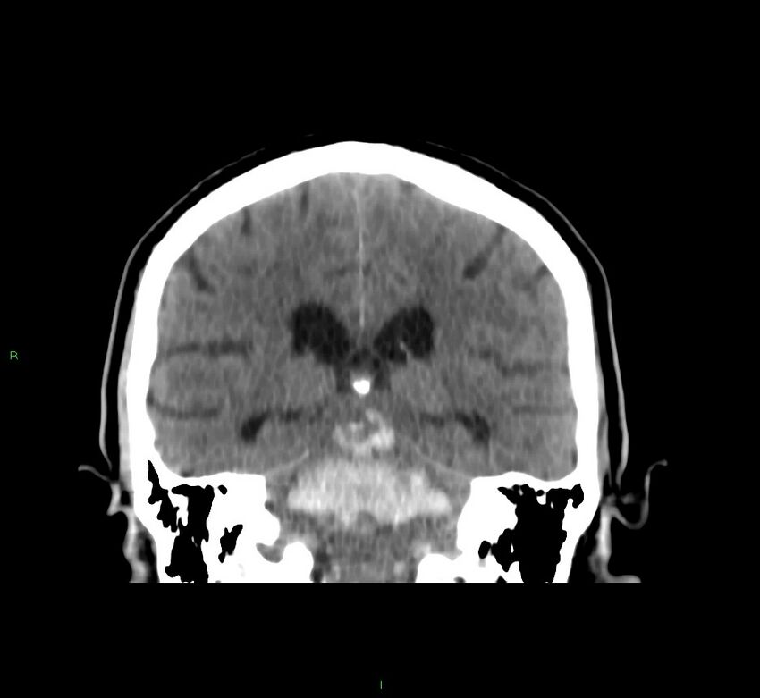 Brainstem hemorrhage (Radiopaedia 58794-66028 Coronal non-contrast 28).jpg