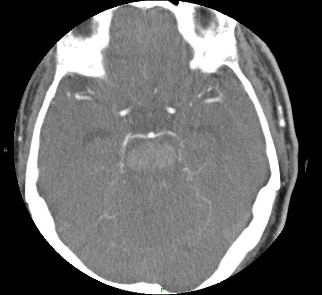 File:Brainstem hemorrhage (Radiopaedia 58794-66028 D 73).jpg
