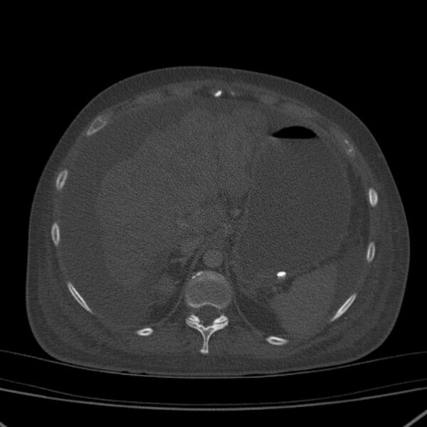 File:Breast cancer metastases - hepatic and skeletal (Radiopaedia 34201-35461 Axial bone window 41).jpg