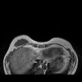 Breast implants - MRI (Radiopaedia 26864-27035 Axial T1 8).jpg
