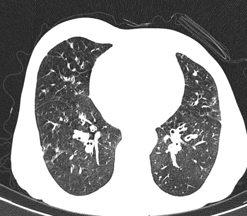 Bronchiolitis (Radiopaedia 24616-24887 Axial lung window 37).jpg