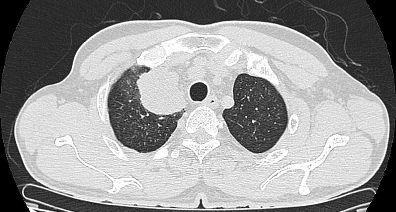 File:Bronchogenic carcinoma with superior vena cava syndrome (Radiopaedia 36497-38054 Axial lung window 17).jpg