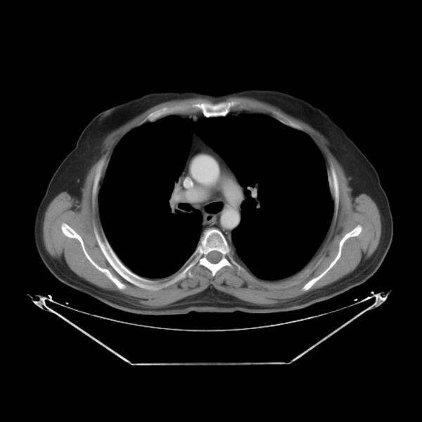File:Bronchogenic carcinoma with upper lobe collapse (Radiopaedia 29297-29726 C 14).jpg
