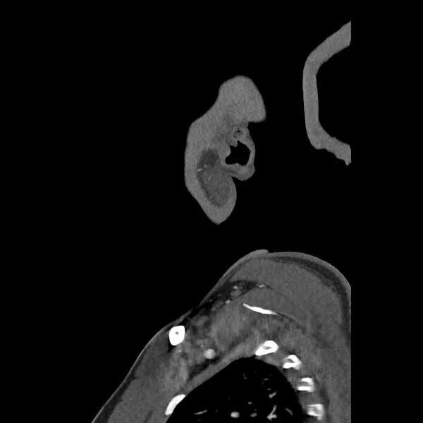 File:Buccal fat pad arteriovenous malformation (Radiopaedia 70936-81144 C 20).jpg