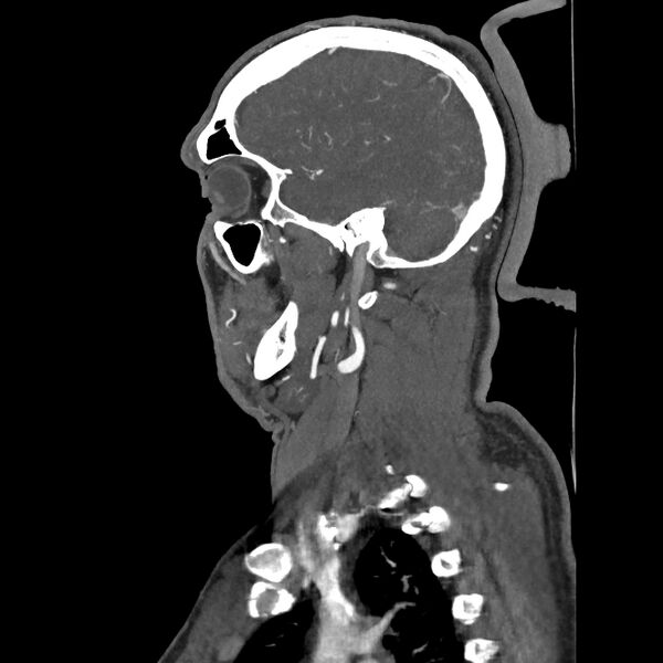 File:Buccal fat pad arteriovenous malformation (Radiopaedia 70936-81144 C 58).jpg