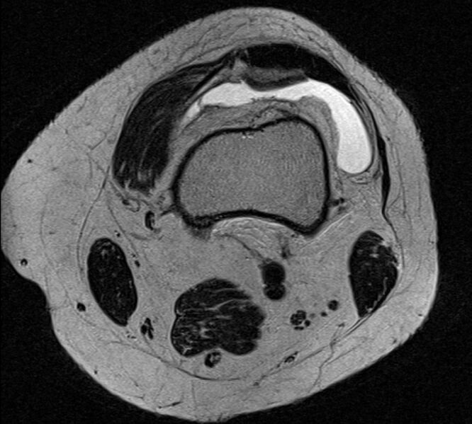 File:Bucket handle tear - medial meniscus (Radiopaedia 79028-91942 Axial T2 25).jpg