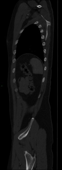 File:Burst fracture (Radiopaedia 83168-97542 Sagittal bone window 102).jpg